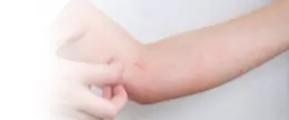 害獣によるノミ・ダニ被害